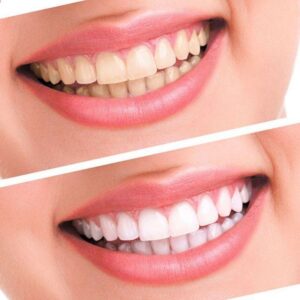 sutton woman white smile with teeth whitening