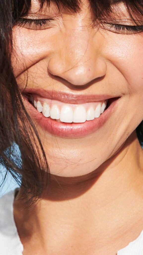 sutton woman smiling with white composite bonding replacement