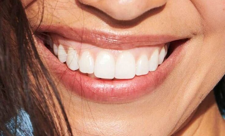 sutton woman smiling with white composite bonding replacement