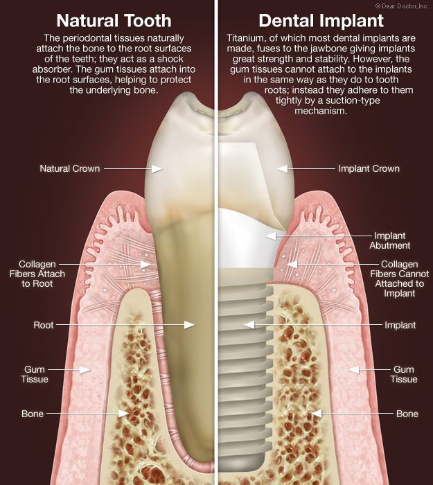 sutton image of dental implant next to tooth to show anatomy and structure of dental implant and tooth together