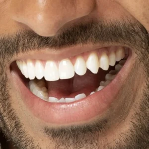 composite bonding in belmont sutton man smiling white teeth smile