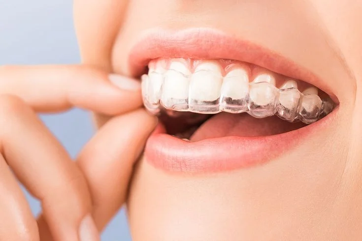 invisalign teeth straightening in belmont sutton woman wearing clear aligners in mouth