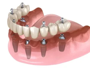 all on four implants denture bridge