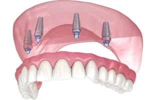 implant denture all on 4 upper plastic complete denture in belmont sutton dentist
