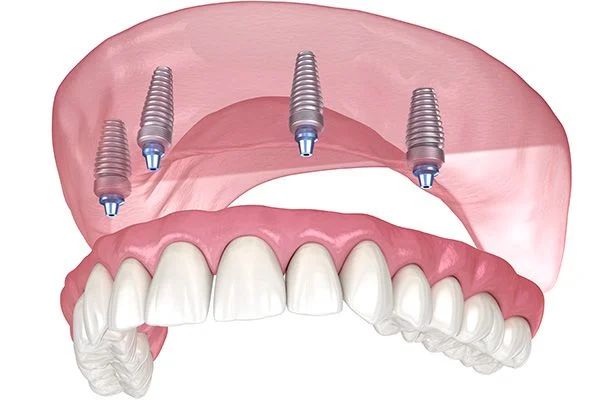 implant denture all on 4 upper plastic complete denture in belmont sutton dentist