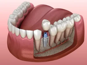 dental implant crown in belmont sutton