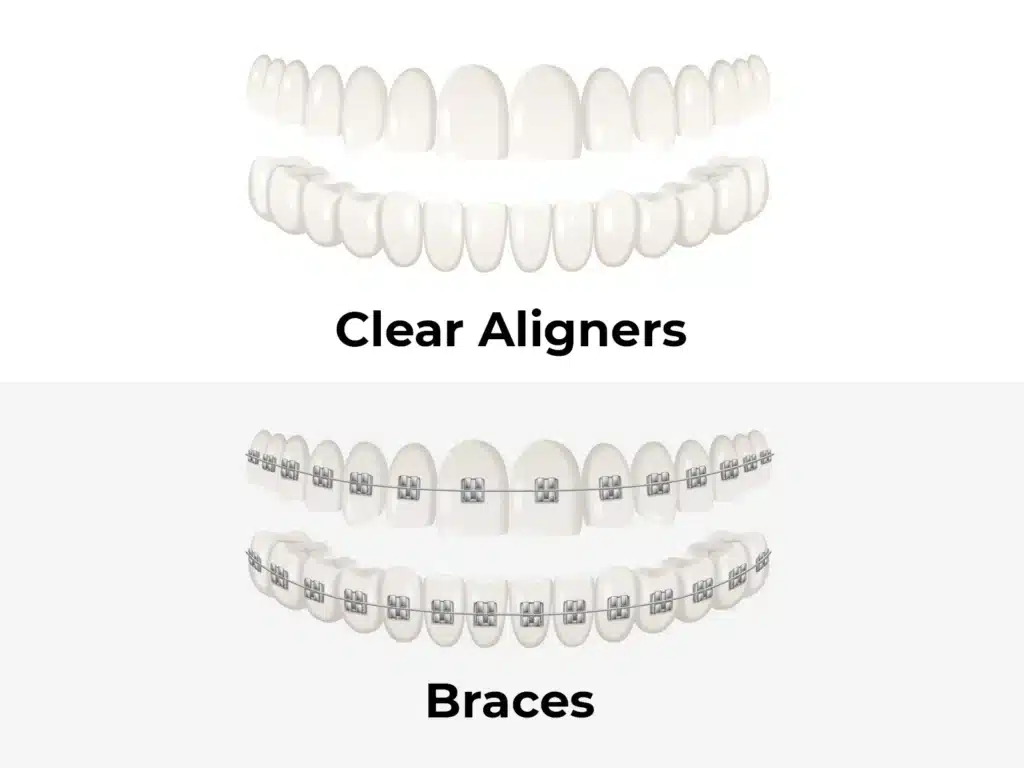 Picture of clear aligners and metal braces